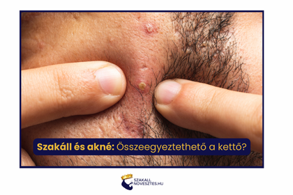 Szakáll és akné: Összeegyeztethető a kettő?